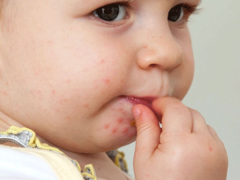 Trẻ sơ sinh bị sốt phát ban do bệnh tay chân miệng