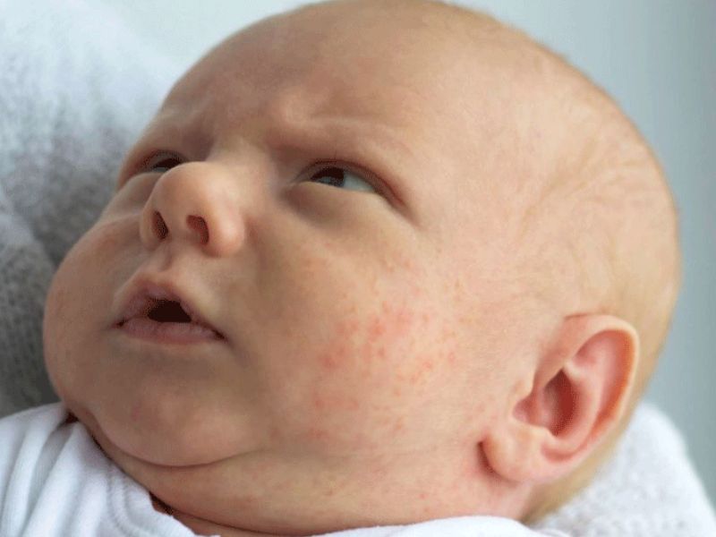 Ba mẹ nên làm gì để trẻ sơ sinh bị sốt phát ban nhanh khỏi?